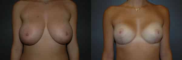 Breast Reduction before and after photo by Dr. Richard A. Bartlett in Brookline, MA