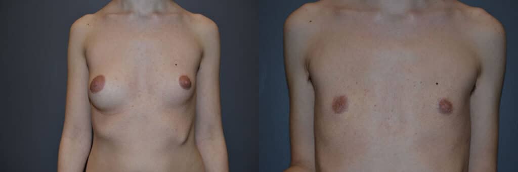 Gender Affirming Surgery before and after photo by Dr. Richard A. Bartlett in Brookline, MA