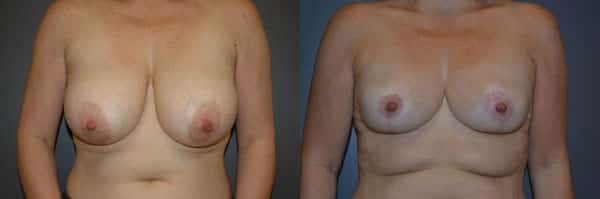 Breast Reduction before and after photo by Dr. Richard A. Bartlett in Brookline, MA