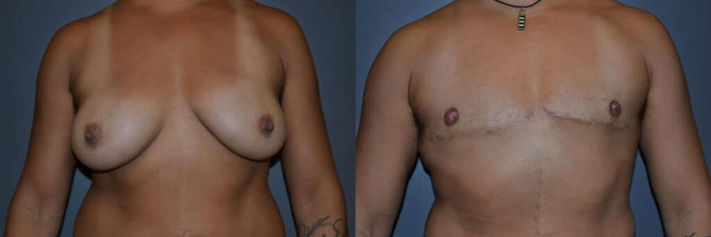 Gender Affirming Surgery before and after photo by Dr. Richard A. Bartlett in Brookline, MA