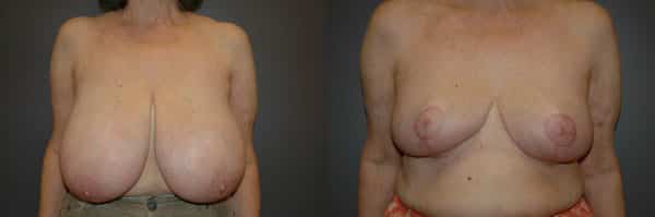 Breast Reduction before and after photo by Dr. Richard A. Bartlett in Brookline, MA