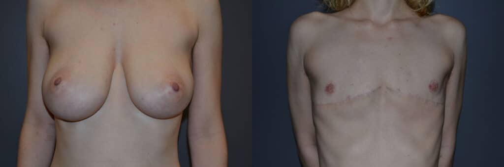 Gender Affirming Surgery before and after photo by Dr. Richard A. Bartlett in Brookline, MA