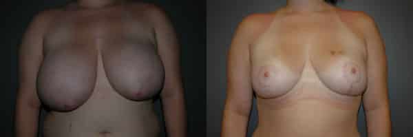 Breast Reduction before and after photo by Dr. Richard A. Bartlett in Brookline, MA