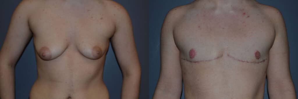 Gender Affirming Surgery before and after photo by Dr. Richard A. Bartlett in Brookline, MA