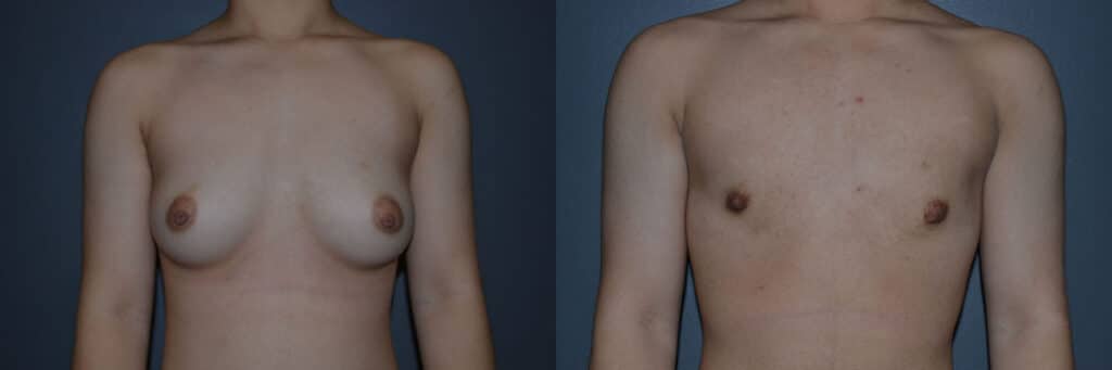 Gender Affirming Surgery before and after photo by Dr. Richard A. Bartlett in Brookline, MA