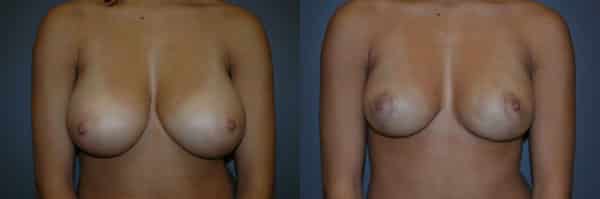 Breast Reduction before and after photo by Dr. Richard A. Bartlett in Brookline, MA