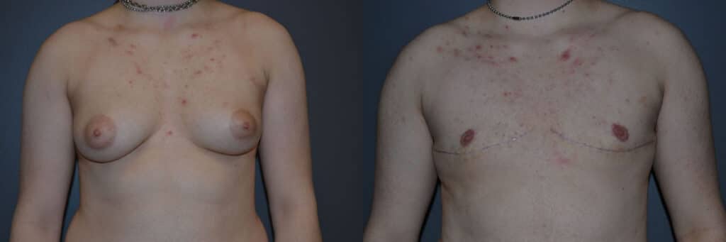 Gender Affirming Surgery before and after photo by Dr. Richard A. Bartlett in Brookline, MA