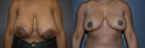 Breast Reduction before and after photo by Dr. Richard A. Bartlett in Brookline, MA