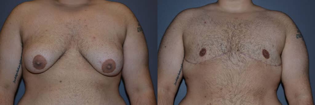 Gender Affirming Surgery before and after photo by Dr. Richard A. Bartlett in Brookline, MA