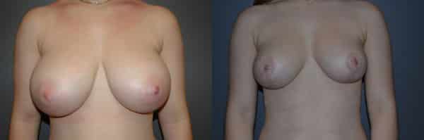 Breast Reduction before and after photo by Dr. Richard A. Bartlett in Brookline, MA