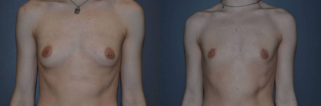 Gender Affirming Surgery before and after photo by Dr. Richard A. Bartlett in Brookline, MA