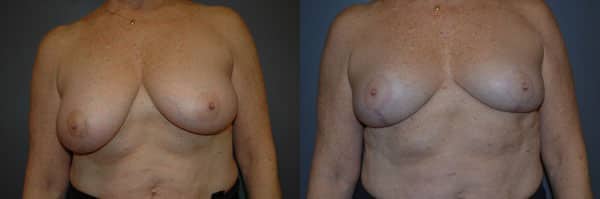 Breast Reduction before and after photo by Dr. Richard A. Bartlett in Brookline, MA