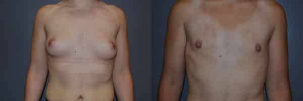Gender Affirming Surgery before and after photo by Dr. Richard A. Bartlett in Brookline, MA