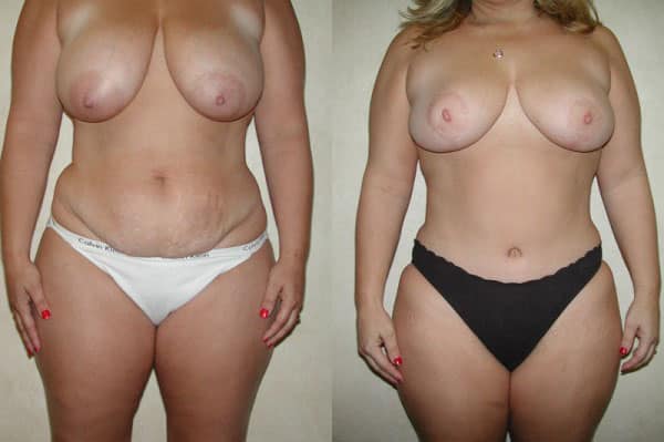 Abdominoplasty (Tummy Tuck) before and after photo by Dr. Richard A. Bartlett in Brookline, MA