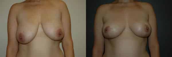 Breast Asymmetry before and after photo by Dr. Richard A. Bartlett in Brookline, MA
