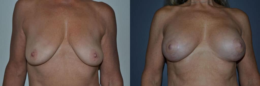 Breast Augmentation before and after photo by Dr. Richard A. Bartlett in Brookline, MA