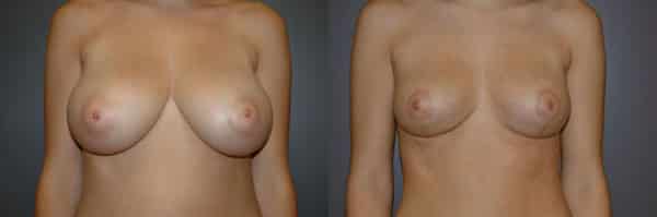 Breast Reduction before and after photo by Dr. Richard A. Bartlett in Brookline, MA
