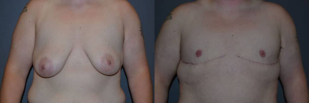 Gender Affirming Surgery before and after photo by Dr. Richard A. Bartlett in Brookline, MA