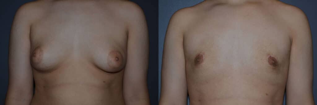 Gynecomastia (Male Breast Reduction) before and after photo by Dr. Richard A. Bartlett in Brookline, MA
