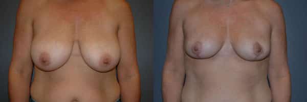 Breast Reduction before and after photo by Dr. Richard A. Bartlett in Brookline, MA