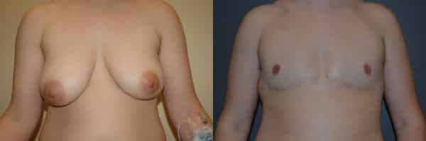 Gender Affirming Surgery before and after photo by Dr. Richard A. Bartlett in Brookline, MA