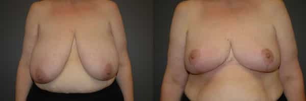 Breast Reduction before and after photo by Dr. Richard A. Bartlett in Brookline, MA