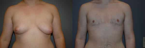 Gender Affirming Surgery before and after photo by Dr. Richard A. Bartlett in Brookline, MA