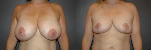 Breast Reduction before and after photo by Dr. Richard A. Bartlett in Brookline, MA