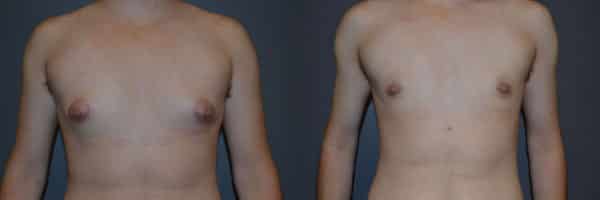 Gender Affirming Surgery before and after photo by Dr. Richard A. Bartlett in Brookline, MA