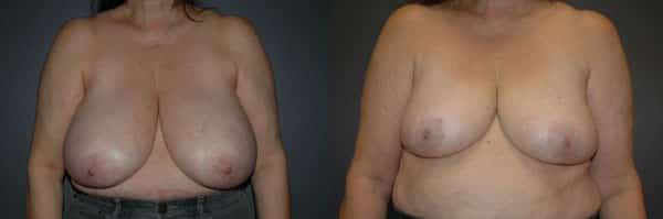 Breast Reduction before and after photo by Dr. Richard A. Bartlett in Brookline, MA
