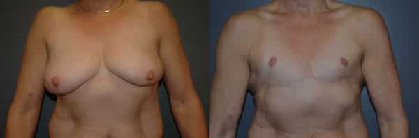 Gender Affirming Surgery before and after photo by Dr. Richard A. Bartlett in Brookline, MA