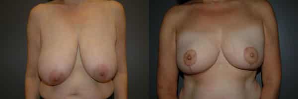 Breast Reduction before and after photo by Dr. Richard A. Bartlett in Brookline, MA