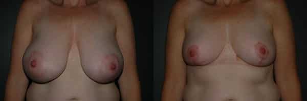 Breast Reduction before and after photo by Dr. Richard A. Bartlett in Brookline, MA