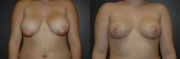 Breast Reduction before and after photo by Dr. Richard A. Bartlett in Brookline, MA