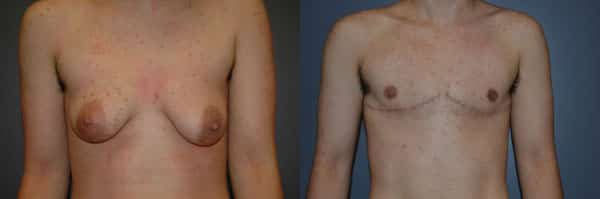 Gender Affirming Surgery before and after photo by Dr. Richard A. Bartlett in Brookline, MA
