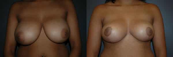Breast Reduction before and after photo by Dr. Richard A. Bartlett in Brookline, MA