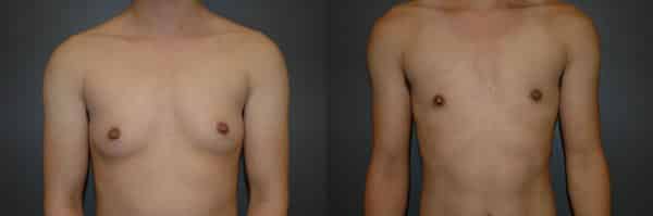 Gender Affirming Surgery before and after photo by Dr. Richard A. Bartlett in Brookline, MA
