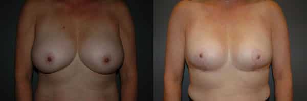 Breast Reduction before and after photo by Dr. Richard A. Bartlett in Brookline, MA