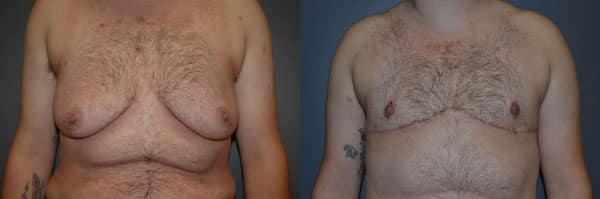 Gender Affirming Surgery before and after photo by Dr. Richard A. Bartlett in Brookline, MA