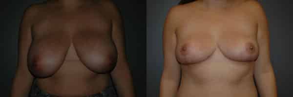 Breast Reduction before and after photo by Dr. Richard A. Bartlett in Brookline, MA