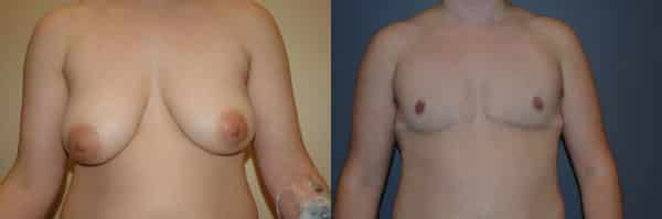 Gender Affirming Surgery before and after photo by Dr. Richard A. Bartlett in Brookline, MA