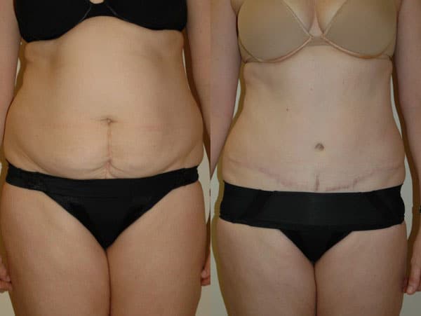 Abdominoplasty (Tummy Tuck) before and after photo by Dr. Richard A. Bartlett in Brookline, MA