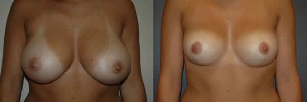 Breast Reduction before and after photo by Dr. Richard A. Bartlett in Brookline, MA