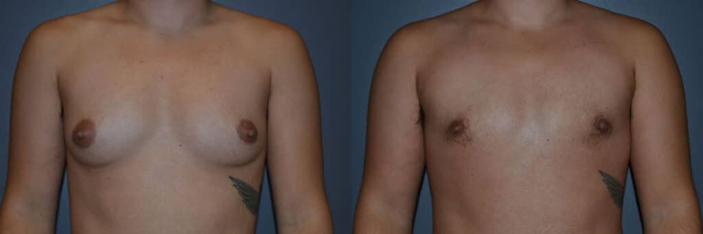 Gender Affirming Surgery before and after photo by Dr. Richard A. Bartlett in Brookline, MA