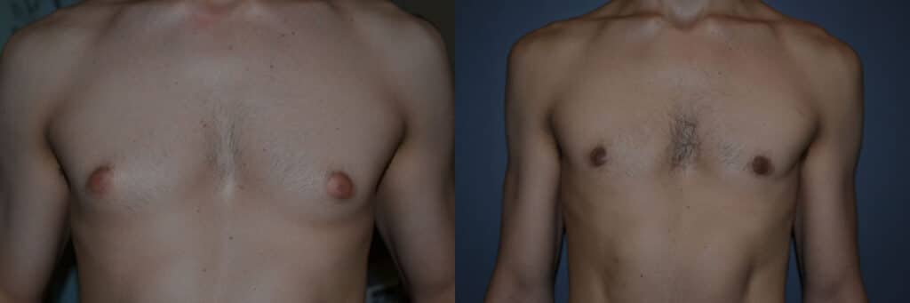 Gynecomastia (Male Breast Reduction) before and after photo by Dr. Richard A. Bartlett in Brookline, MA