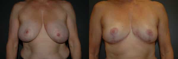 Breast Reduction before and after photo by Dr. Richard A. Bartlett in Brookline, MA