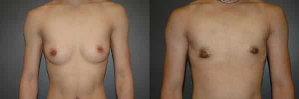 Gender Affirming Surgery before and after photo by Dr. Richard A. Bartlett in Brookline, MA