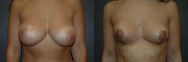 Breast Reduction before and after photo by Dr. Richard A. Bartlett in Brookline, MA