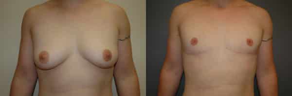 Gender Affirming Surgery before and after photo by Dr. Richard A. Bartlett in Brookline, MA