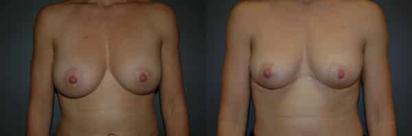Breast Reduction before and after photo by Dr. Richard A. Bartlett in Brookline, MA